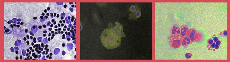 Immune cells in uveitis
