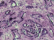 Prostate cancer cells.