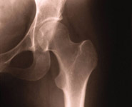 A close-up of a human hip x-ray