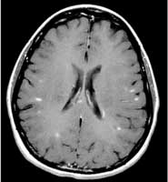 T1 weighted MRI brain scan in MS